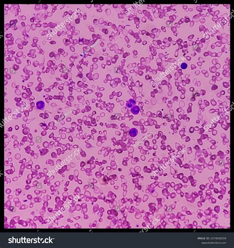 Rbc Membrane Disorders: Over 3 Royalty-Free Licensable Stock Photos | Shutterstock