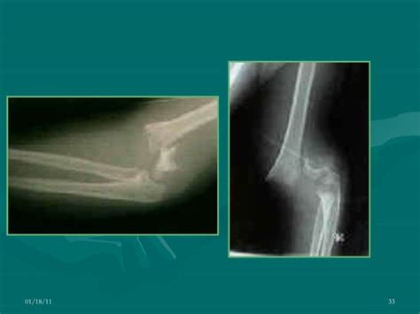 Fractura supracondílea intercondílea humeral PPT