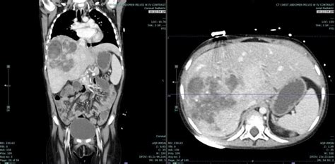 [Figure, Hepatoblastoma Contributed by Melinda Smith MD, West Virginia ...