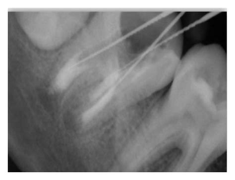 A Preoperative B And C Working Length Determination D Mta