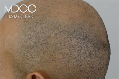 Cicatrices Micropigmentation Cheveux Paris Marseille Toulon Et