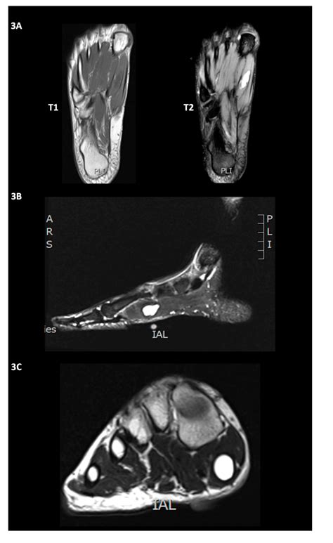 Foot Muscles Mri - Mri Scan London Sports Orthopaedics - hip pelvis thigh knee lower extremity ...