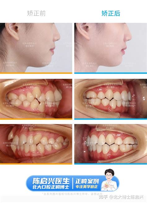 拒绝乱牙牙齿拥挤不齐 个别牙反颌案例 知乎