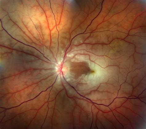 Two Common Tests for Retinal Conditions - Southeastern Retina Associates