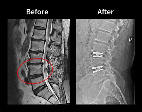 4 Spinal Discs Replaced In The Same Surgery Savants Story Spine