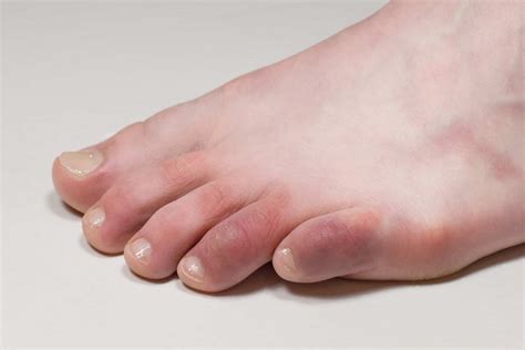 Red Toe Rash Could It Be COVID Toes Feet First Clinic