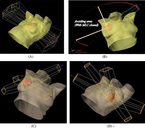 Dosimetric Comparison Of D Conformal Imrt And V Mat Techniques For