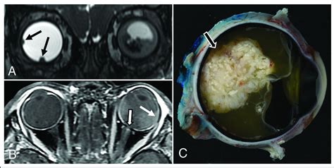 Retinoblastoma What The Neuroradiologist Needs To Know American Journal Of Neuroradiology