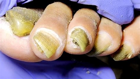 Complete Trimming Of Onychomycosis And Removal Of Dirtdr Liu S