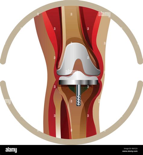 Prosthetic Tibia Stock Vector Images Alamy