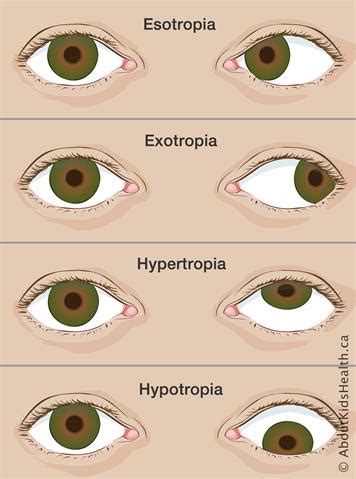 Do You Know The Symptoms And Treatment For Strabismus