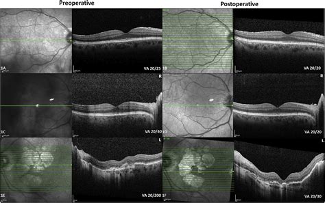 Eye Condition Asteroid Hyalosis