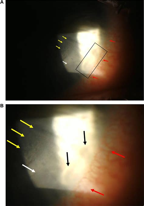 Figure 1 From Marginal Keratitis With Secondary Diffuse Lamellar Keratitis After Small Incision