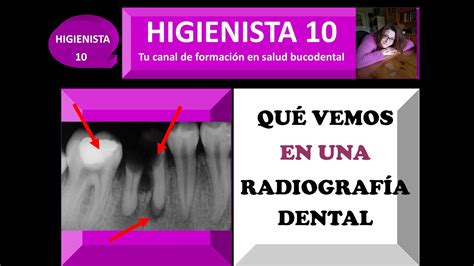 QUÉ VEMOS EN UNA RADIOGRAFÍA DENTAL CÓMO ANALIZAR Y DESCIFRAR UNA