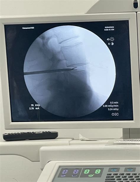 Eliquence Disc Fx And Endoscopic Rhizotomy • Trusha Shah Md