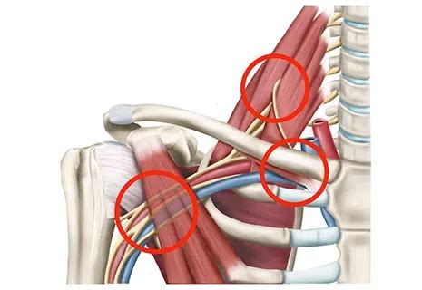 Thoracic Outlet Syndrome TOS What You Need To Know