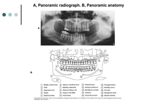 PPT - PANORAMIC RADIOGRAPHY PowerPoint Presentation - ID:3271319