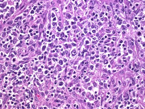 The Blood Unit – Diffuse Large B Cell Lymphoma