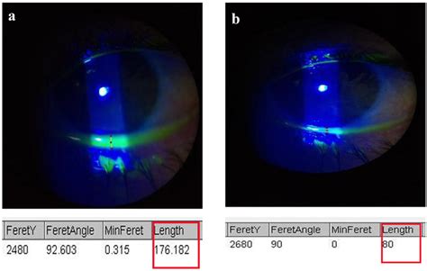 A Pre Argon Laser Treatment Tear Film Thickness Equal To 176 Pixels B