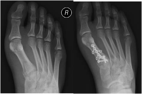 Metatarsal Fractures A Review And Current Concepts Tarek