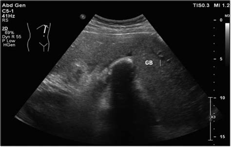 Rare Case Of Gallbladder Agenesis Presenting With Pancreatitis Bmj Case Reports