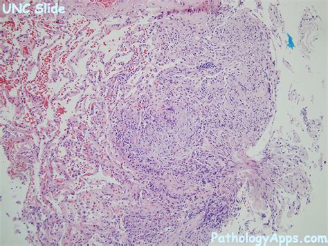 hypersensitivity pneumonitis pathology