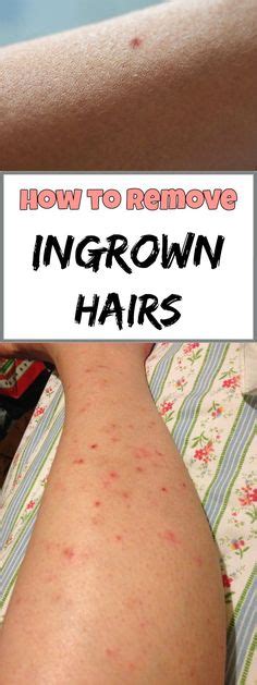 How To Treat Legs Ingrown Hair Ingrown Hair