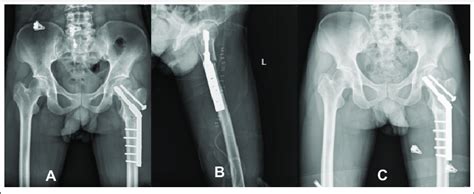 A Showing Immediate Post Op Pelvis With Femur X Ray B Immediate Post