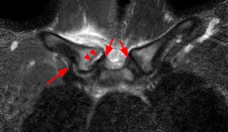 Ligaments Of Sternoclavicular Joint