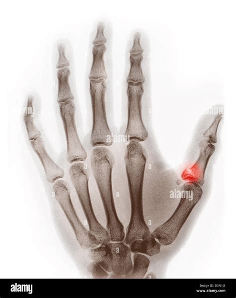 x-ray showing an avulsion fracture of the proximal phalanx of the thumb ...