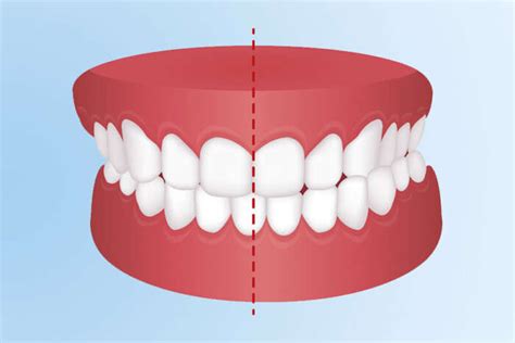 Maloclusión Dental ¿qué Es Y Cómo Corregirla