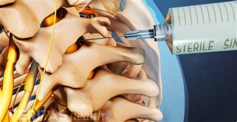 Caudal Steroid Injection Chicago | Metropolitan Institute of Pain