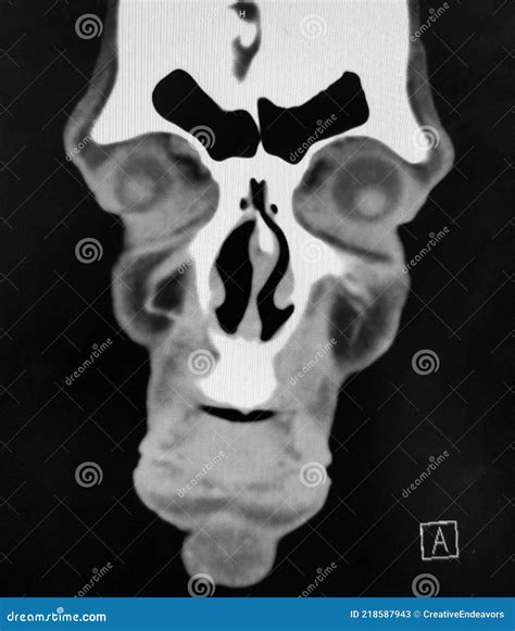 Sinus Tumor Ct Scan