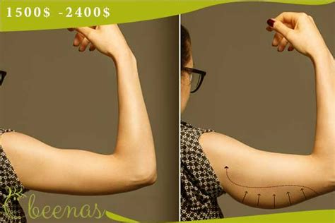 Arm Lift In Turkey Beenas Beauty Clinic