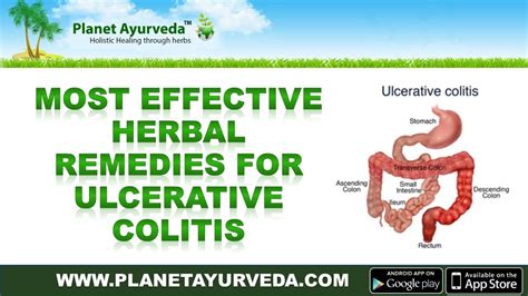 Top 10 Most Effective Herbs To Cure Ulcerative Colitis Naturally Youtube