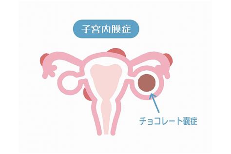 子宮筋腫と子宮内膜症の症状･原因･治療 妊娠できる？｜四条烏丸レディースクリニック