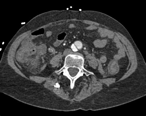 Aortic Dissection Ct Scan