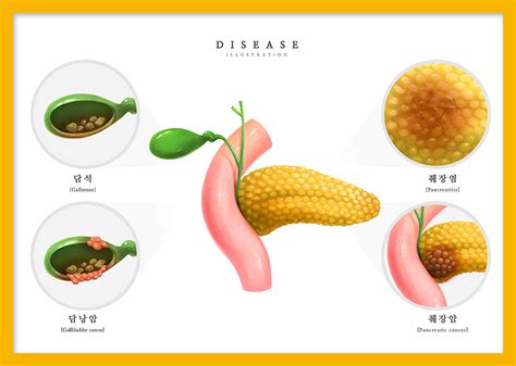 췌장암 조기 발견율이 어려운 이유 건강검진정보