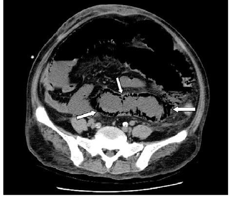 Abdominal Computed Tomography 4 Days Later Revealed Intramural Gas