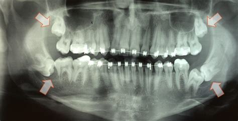 Extra O Dente Do Siso Resultados Dr Fernando Zugno Kulczynski