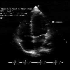 Two Dimensional Echocardiograms A Long Axis View Left And A Short