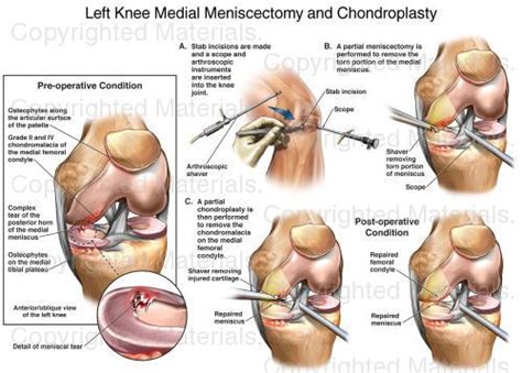 Arthroscopic Partial Medial Meniscectomy Icd 10