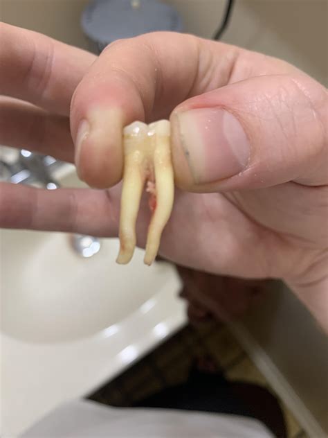 My Tooth Has Really Long Roots R Oddlyterrifying