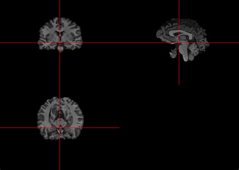 Lecture Skull Stripping With Fsls Brain Extraction Tool Bet