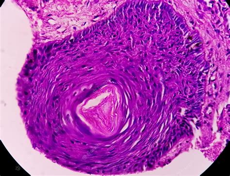 Biopsia De Piel Bajo Microscopía Sugestiva De Carcinoma De Células