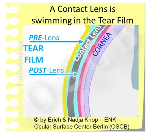 Overview Of Contact Lenses Ocular Surface Center Berlin