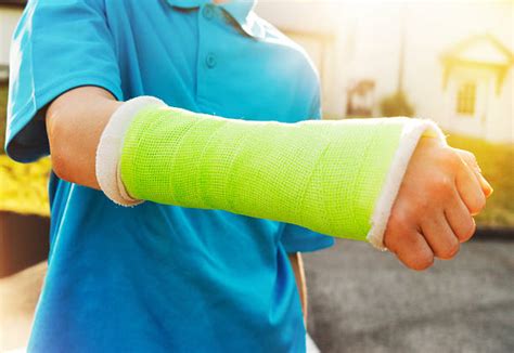 Broken Arm Pictures Images And Stock Photos Istock