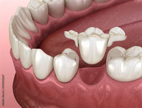 Maryland Bridge Made From Ceramic Premolar Tooth Recovery Medically