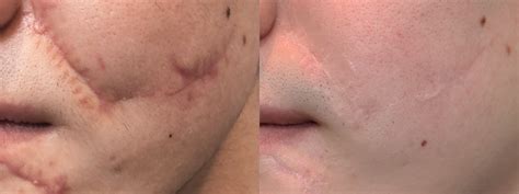 Profractional Laser Treatment A Comprehensive Overview Dr Mirko