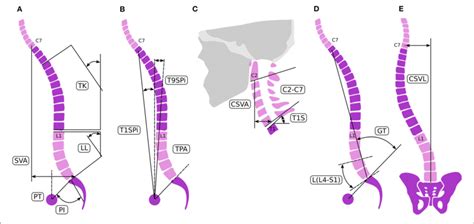 Spinal Alignment Evaluation Sagittal Spino Pelvic Parameters A C Download Scientific